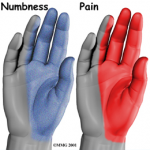 Image of carpal tunnel symptom distribution