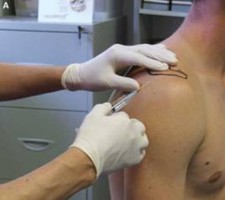 Steroid injections shoulder tendonitis